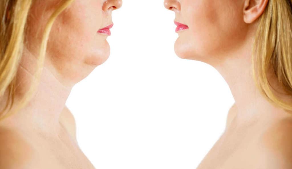 Double Chin treatment Wigan before and after results