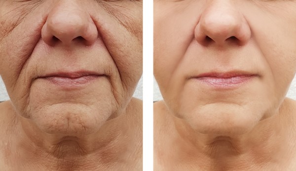 Learn more about Morpheus8 Treatment Wigan today!