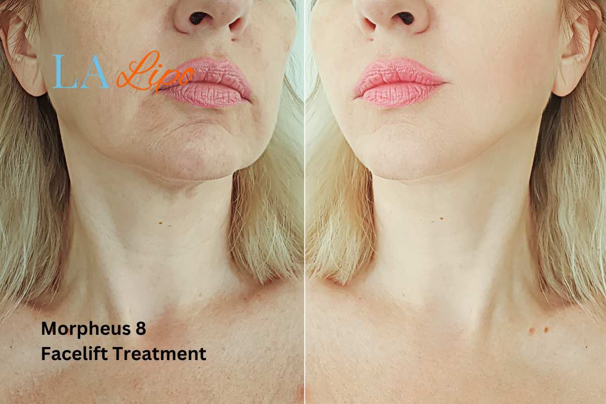Turn back time with Morpheus8 Treatment Wigan