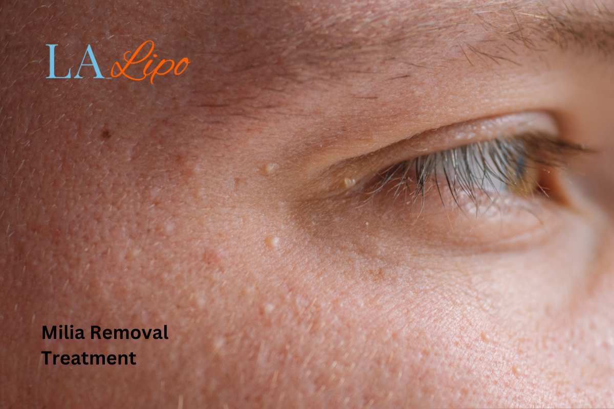 Cryopen Milia Removal: Is It the Easiest and Safest Option Wigan?