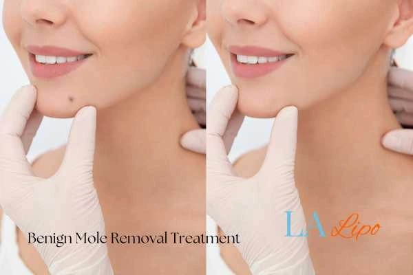woman's before and after mole removal Wigan results