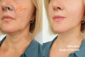 hi-fu for wrinkles Wigan before and after results