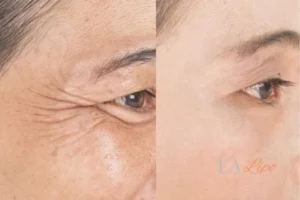 Before and after results of woman - HI-fu wrinkles reduction treatment Wigan