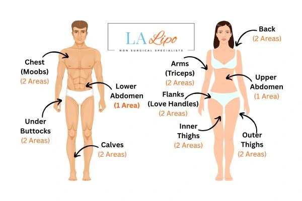LA LIPO Cryolipolysis Areas Wigan