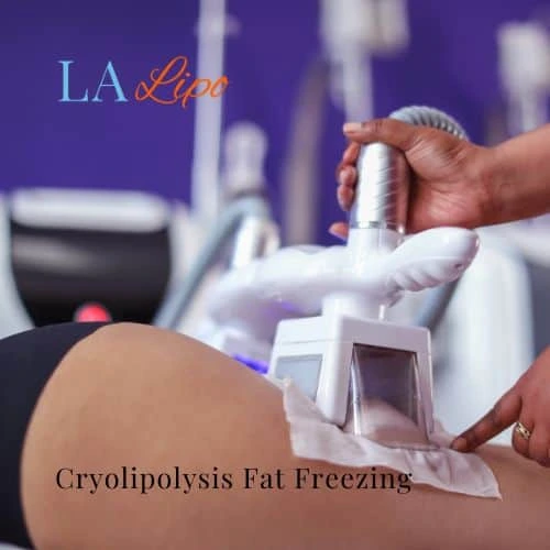 fat freezing - Cryolipolysis Wigan