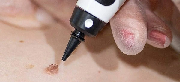 skin tag removal using cryopen Wigan