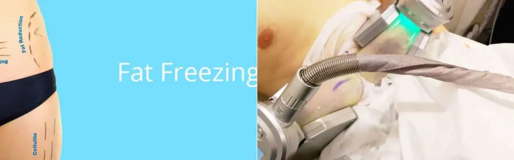multi areas of a persons body having coolsculpting Wigan treatment