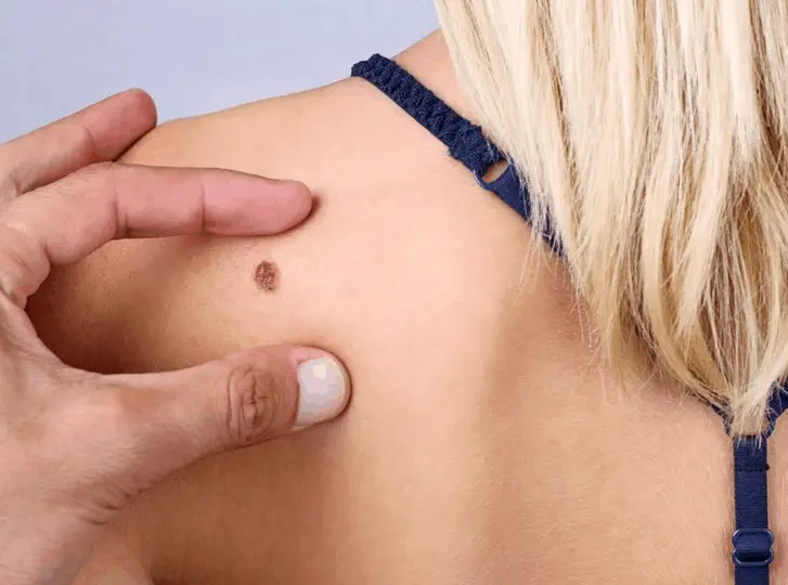 woman having mole removal Wigan consultation before treatment.