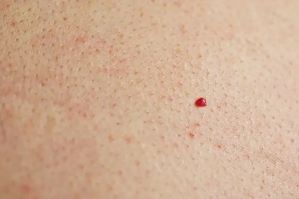 close up of a cherry angioma Wigan