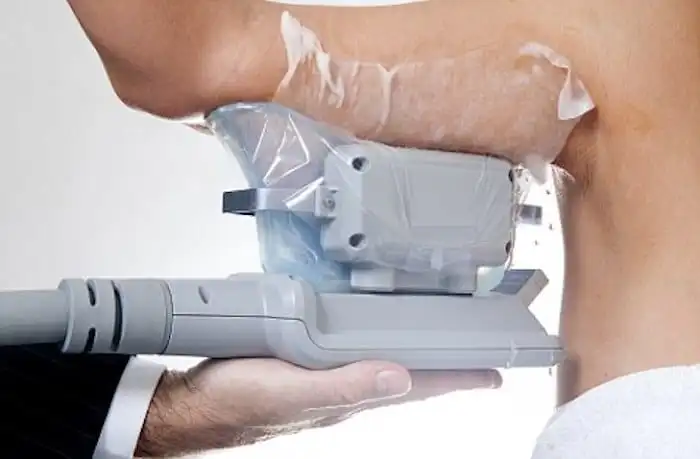 Picture of fat freezing Wigan on the upper arms.