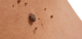 image of a skin tag Wigan