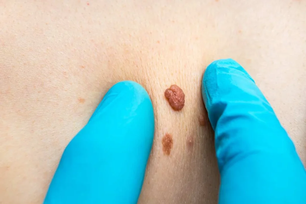 Consultant examining a skin tag Wigan