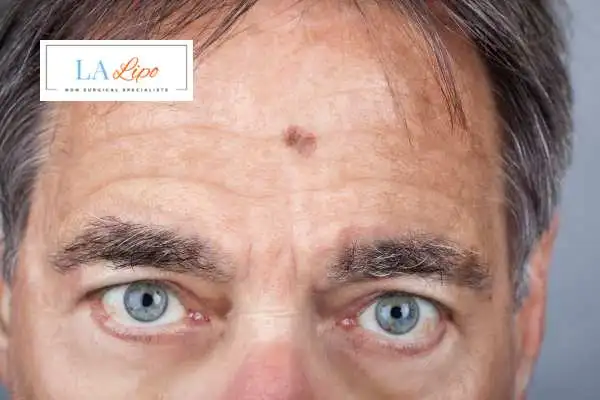 Solar Lentigo Removal Wigan image of man with mark on his forehead