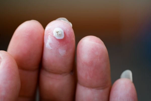 wart on person finger - cryotherapy to treat from LA LIPO Wigan