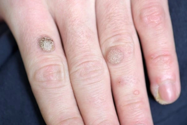 photo of warts on person hand - see wart removal Wigan from LA LIPO