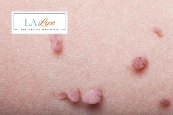 Does cryopen skin tag removal Wigan hurt? Find out now call our team today!