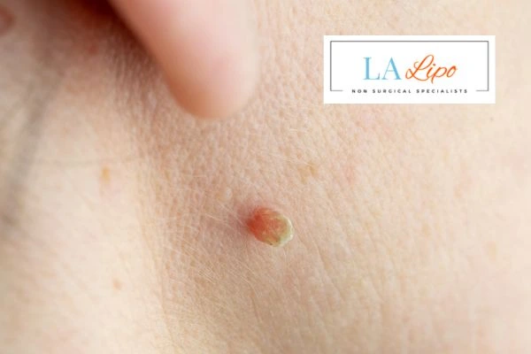 Book skin tag removal Wigan today speak to our team now!