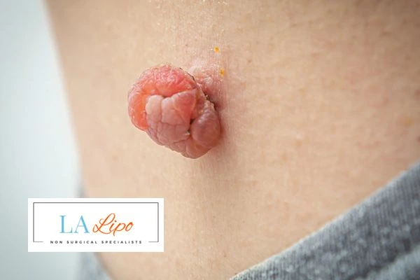 Interested in skin tag removal Wigan? Concerned about the pain? Find out more today!