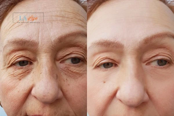 The powerful benefits of Morpheus8 Treatment Wigan - Call Our team today!