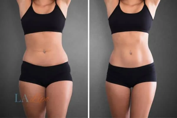 before and after results of non-surgical treatment to help a woman's body image and mental health Wigan