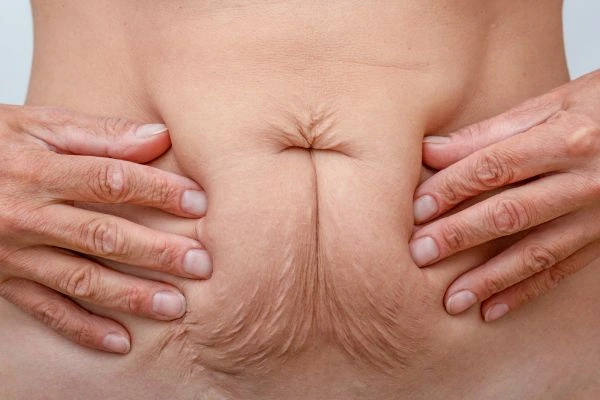 Should I Combine Diastasis Recti Treatment with Body Contouring for Better Results Wigan?